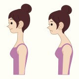 Torticolis 5 posture