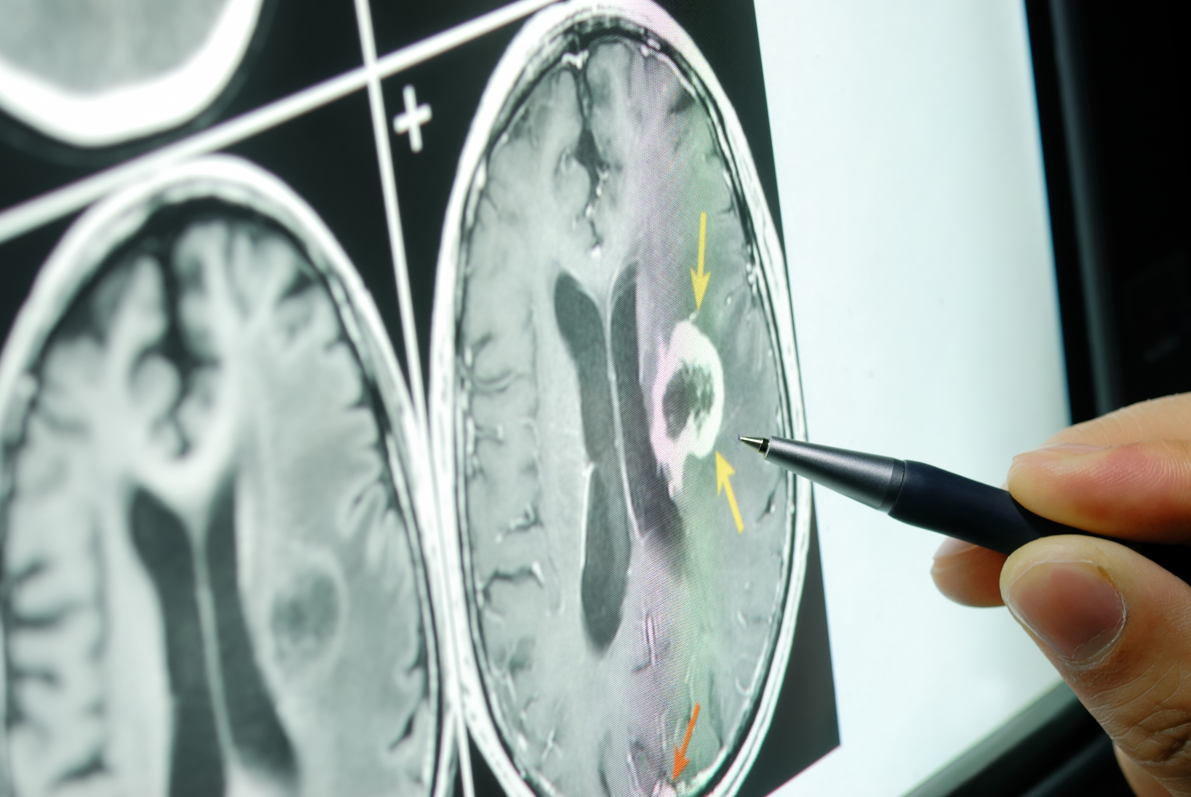 douleur cerveau étude