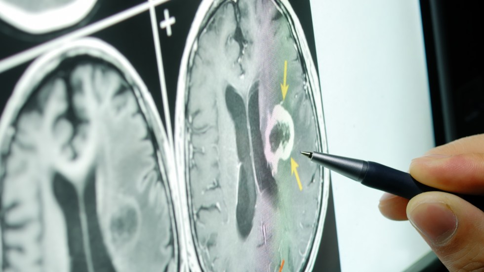 douleur cerveau étude