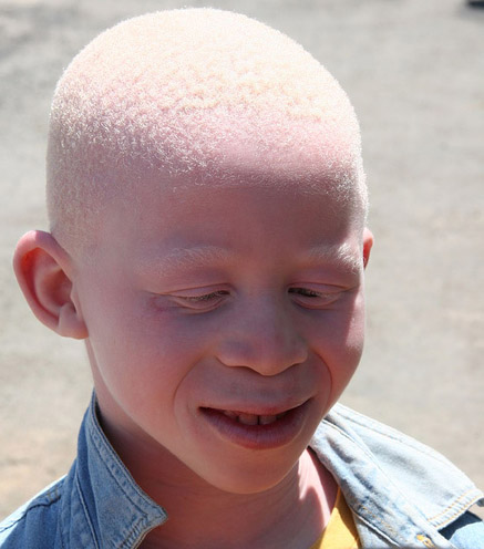 Enfant albinos