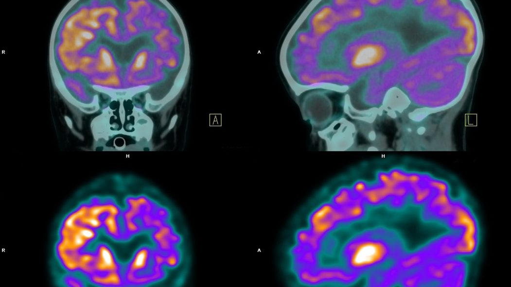 Une recherche détaille une nouvelle méthode de diagnostic qui serait, selon les auteurs de l'étude, capable de détecter 91% des cas de maladies d'Alzheimer.