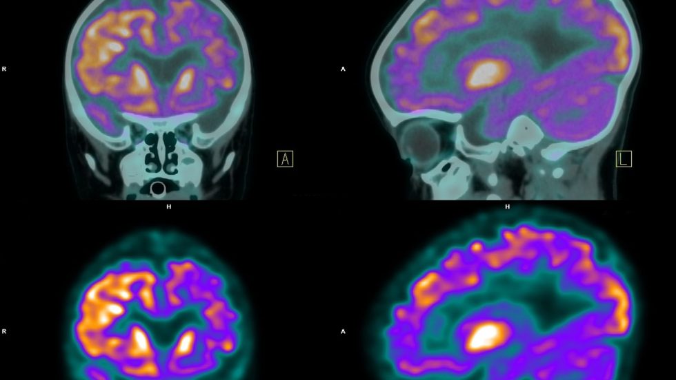 Une recherche détaille une nouvelle méthode de diagnostic qui serait, selon les auteurs de l'étude, capable de détecter 91% des cas de maladies d'Alzheimer.