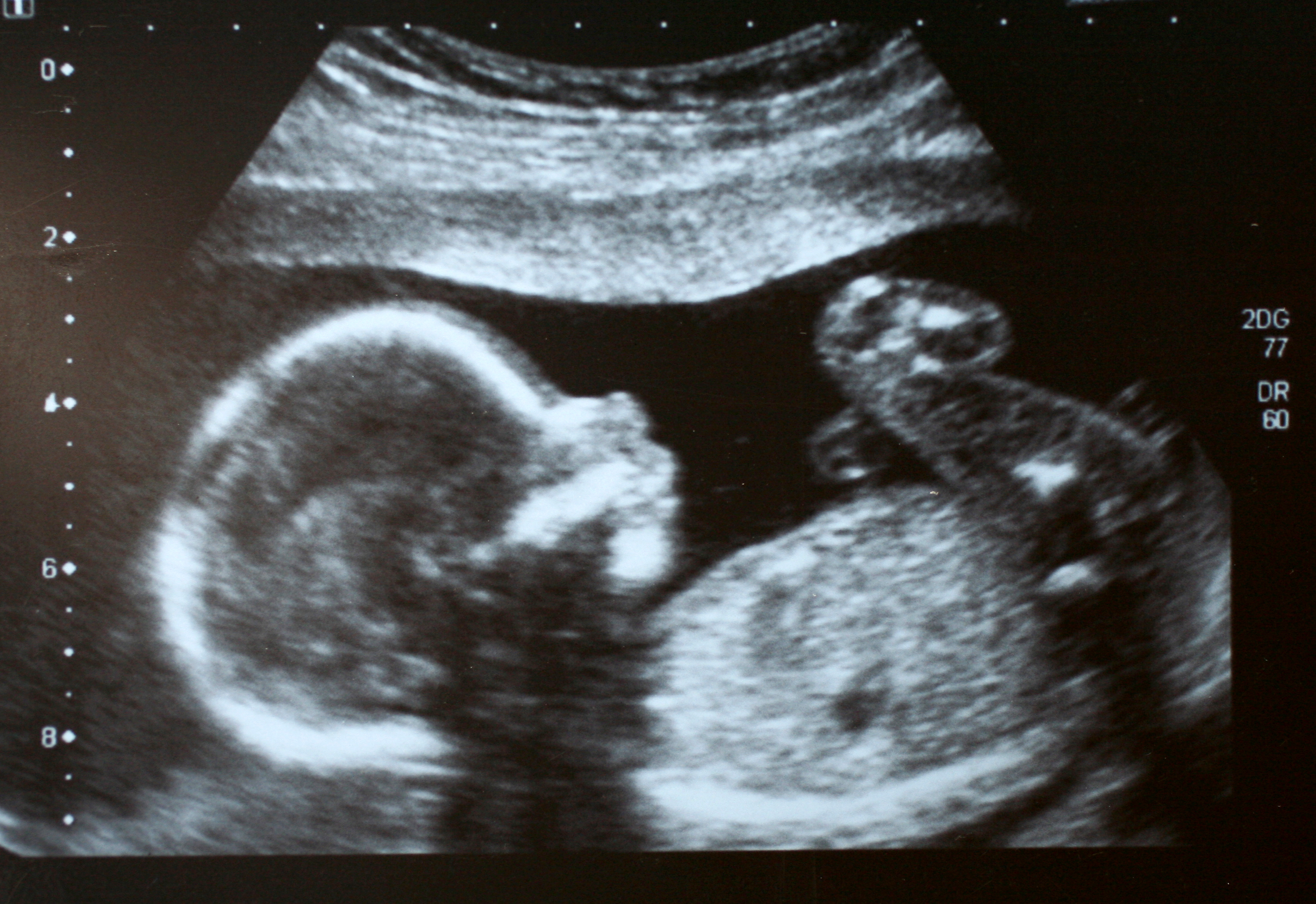 foetus musique