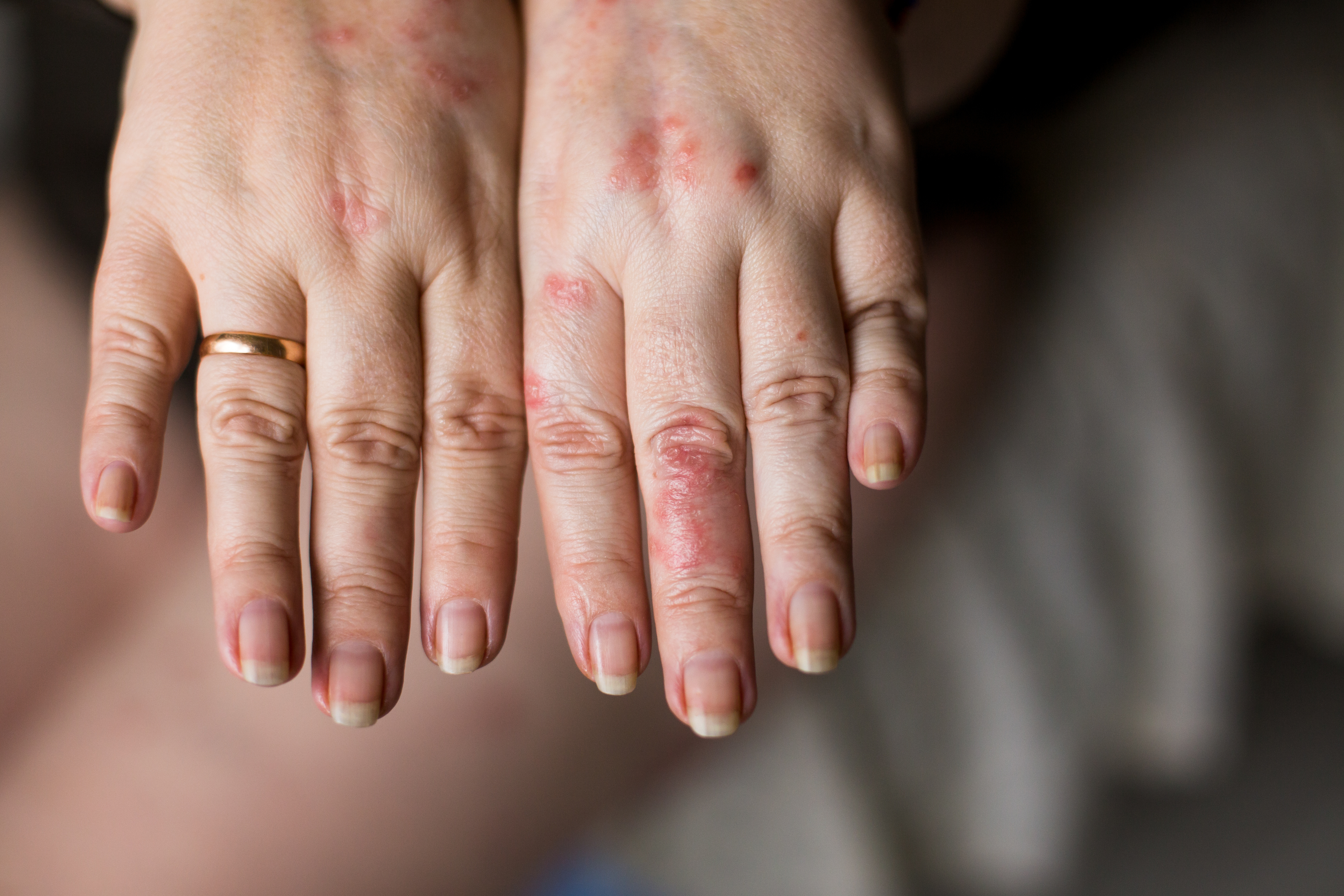 Mains gercées par les gels hydroalcooliques non conformes