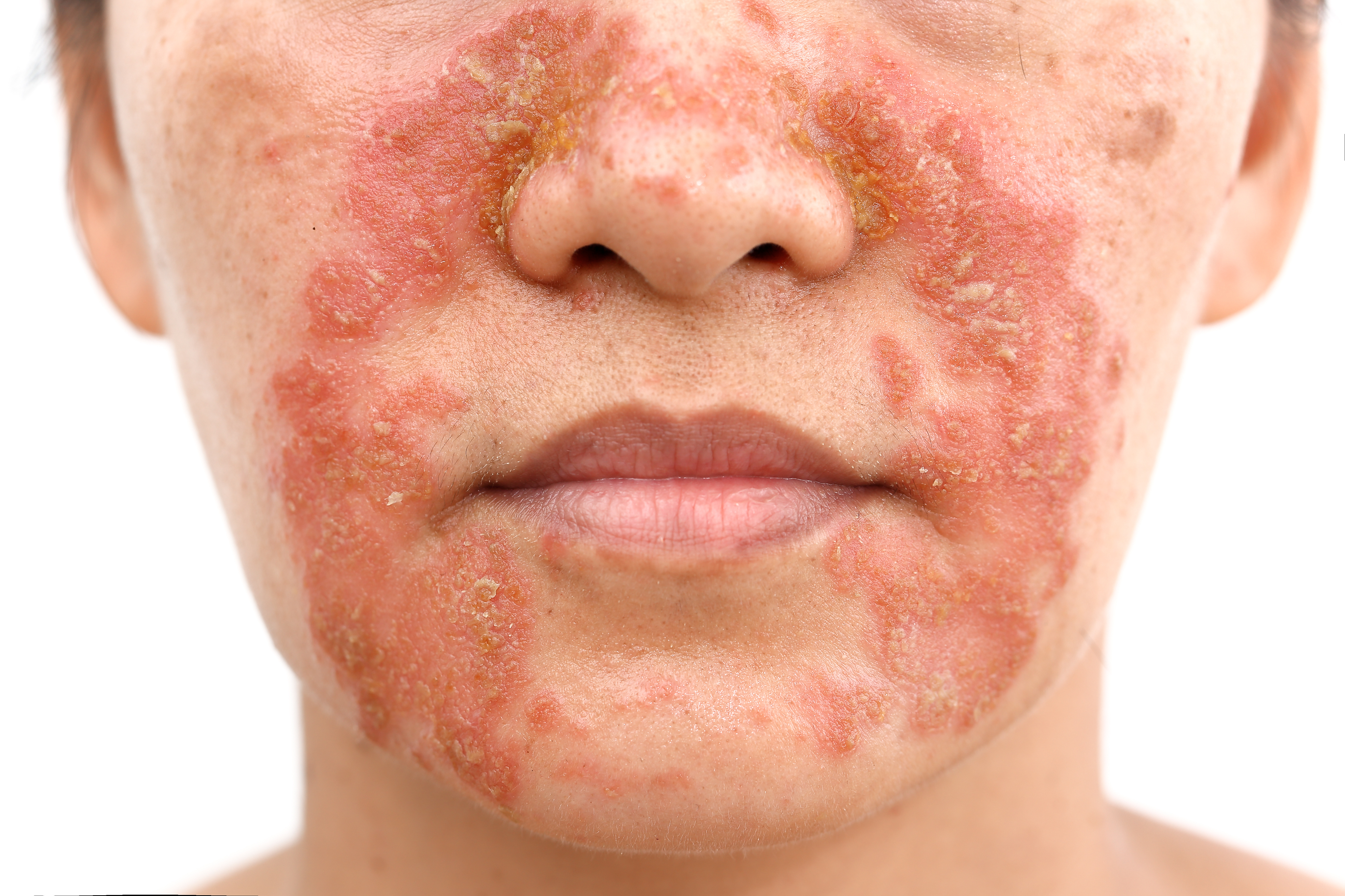 Femme moyennement atteinte par le psoriasis autour de la bouche